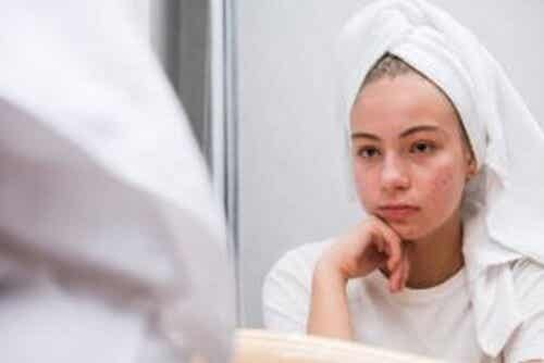 Efectos psicológicos del acné juvenil